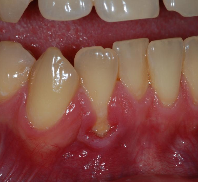 Gingival Grafting 