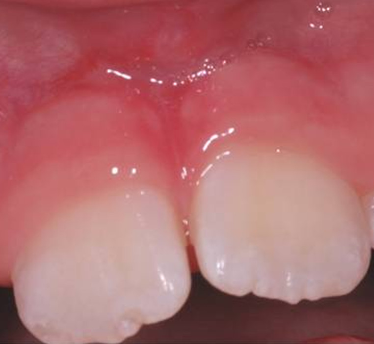 Frenectomy