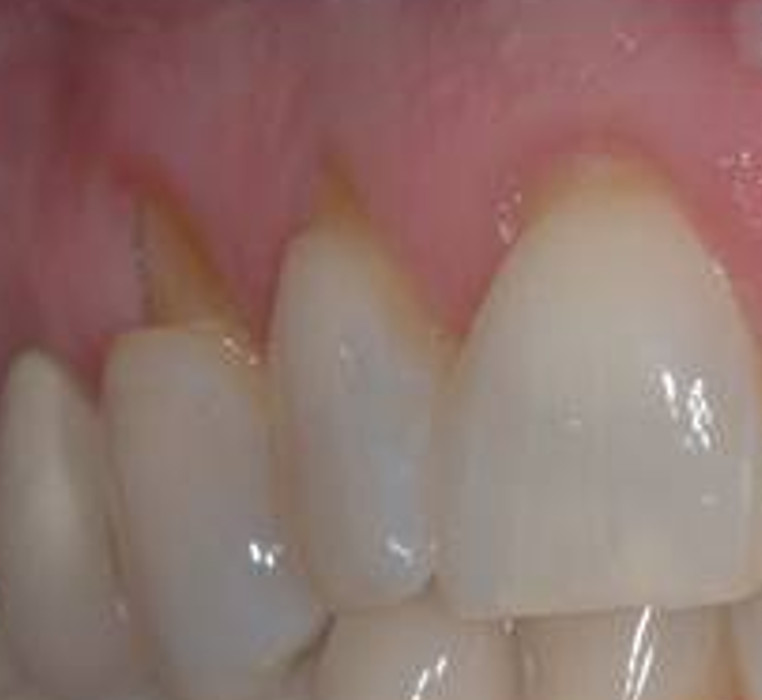 Gingival Grafting 