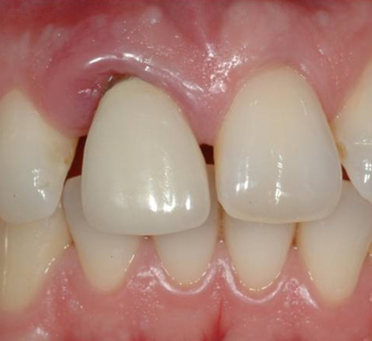 Implant replacement