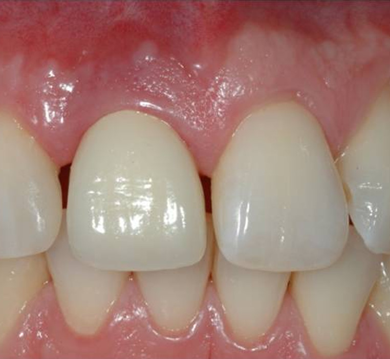 Implant replacement