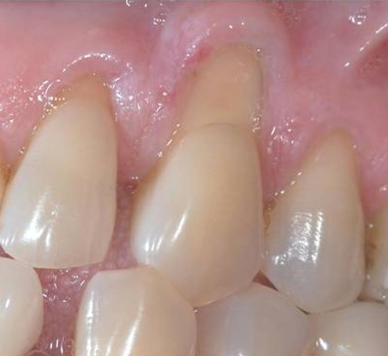 Gingival Grafting 