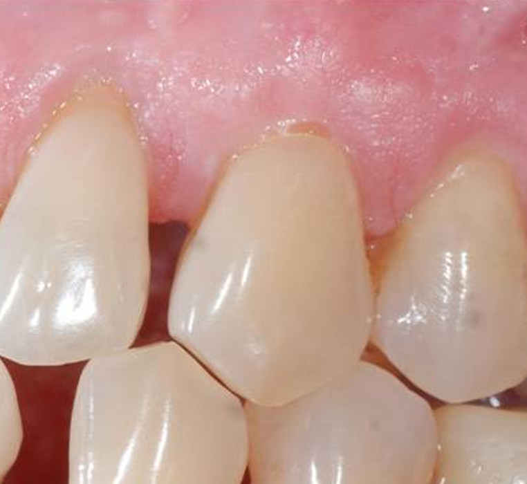 Gingival Grafting 