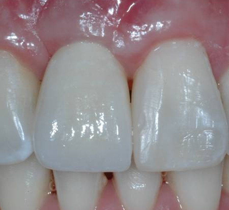 Implant replacement